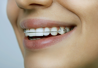 3 Main Alternatives To Metal Braces For Adults