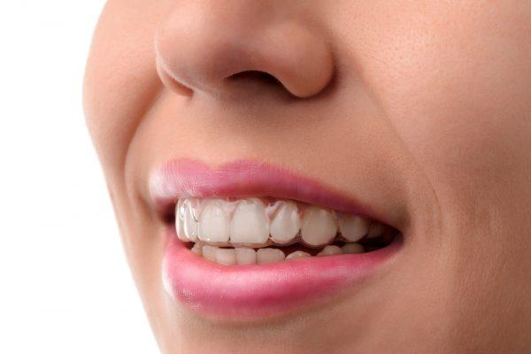 4 Advantages Of Teeth Straightening