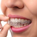 4 Advantages Of Teeth Straightening