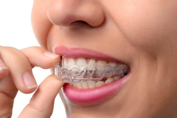 4 Advantages Of Teeth Straightening