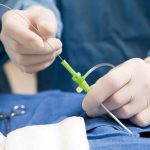 Myths About Laser Spine Surgery