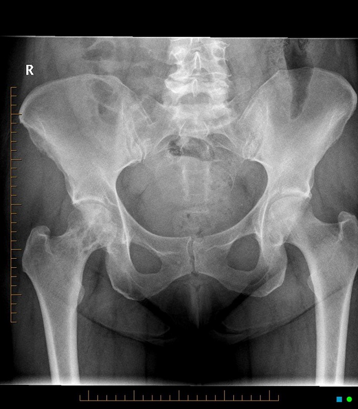 Bone Metastasis In Relation To Cancer