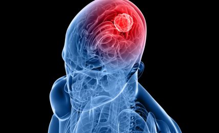 5 Warning Signs Of A Brain Tumor You Need To Know