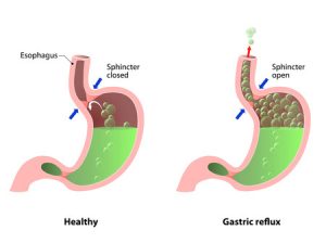 Key Signs and Symptoms Of IBS