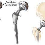 Tips You Need To Follow For A Successful Hip Replacement Surgery