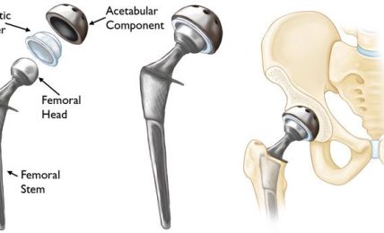 Tips You Need To Follow For A Successful Hip Replacement Surgery