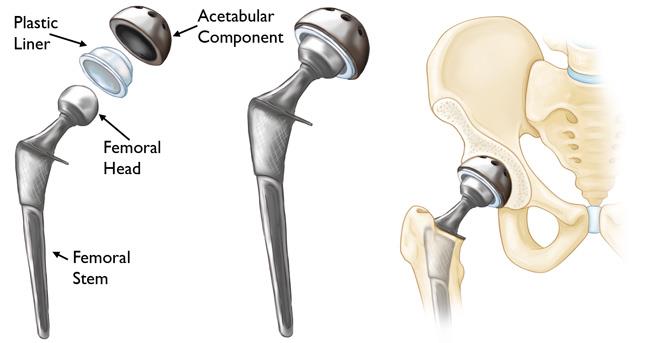 Tips You Need To Follow For A Successful Hip Replacement Surgery