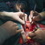 Open heart Surgery