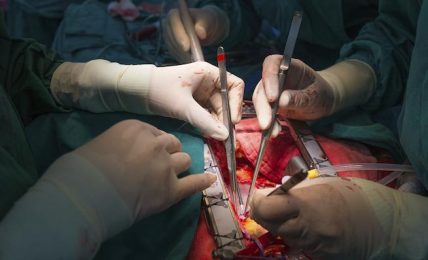 Open heart Surgery